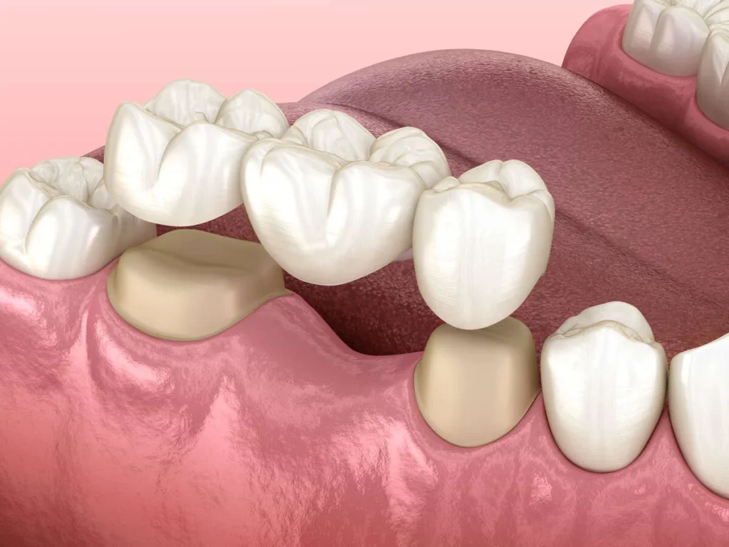 Dental Bridges