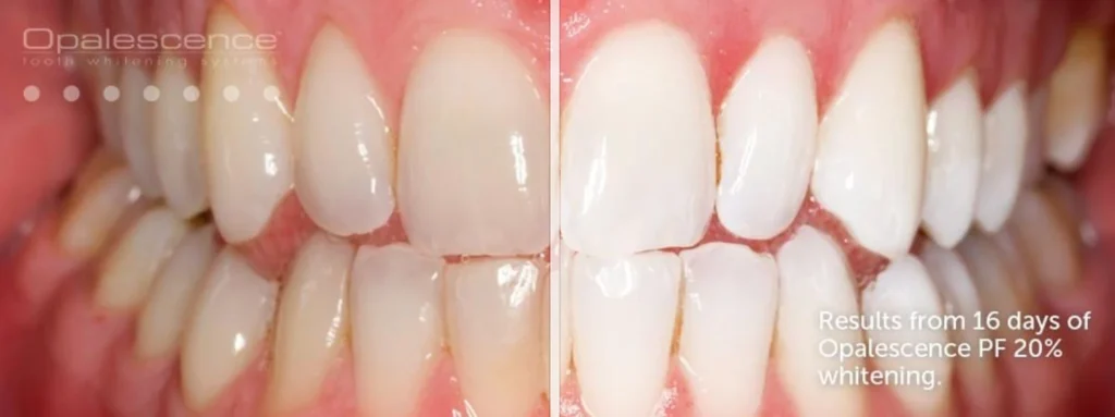 Teeth-Whitening-Result